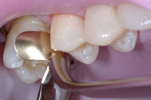 2x COMPOSI-TIGHT Gold Matrizen Bicuspid AU100 (17341)